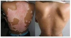 重庆重庆朝天门医院治疗白癜风案例对比