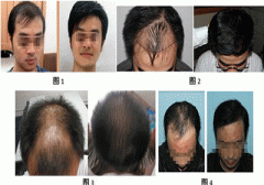 重庆重庆朝天门医院治疗脱发案例