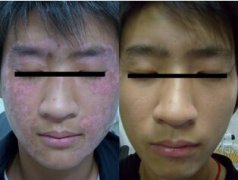 重庆重庆朝天门医院白癜风案例