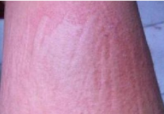 重庆看荨麻疹哪家医院比较好