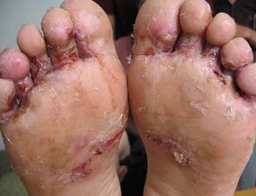 手足癣