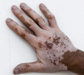 白癜风出现原因