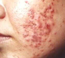 青春痘